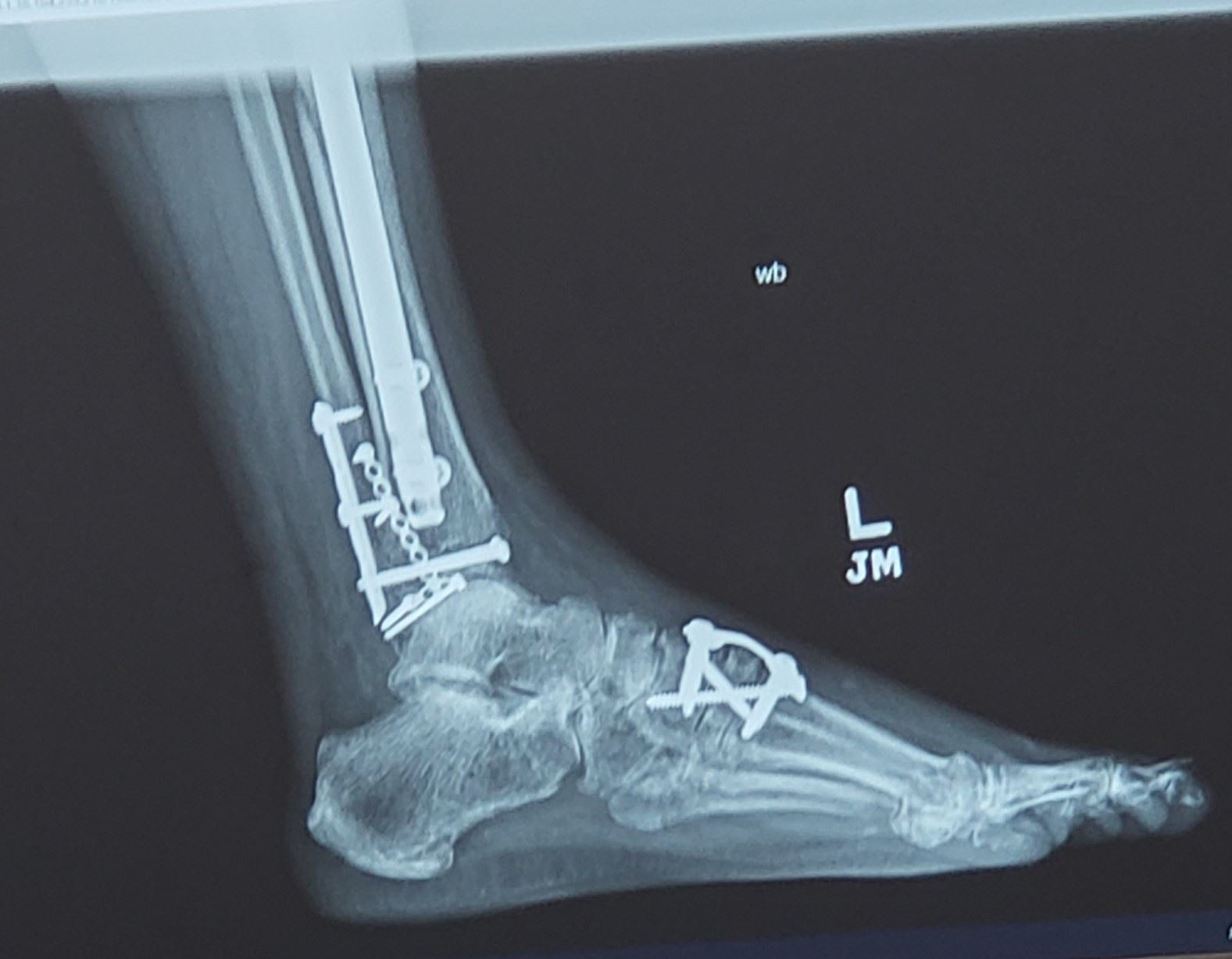 X-ray of patient's foot with screws and hardware